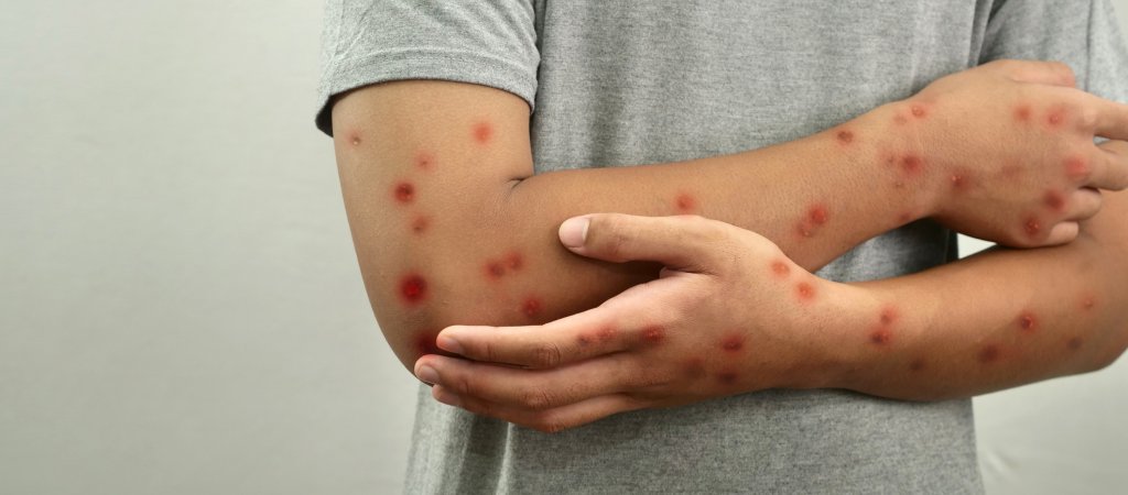 Bessere Mpox-Aufklärung