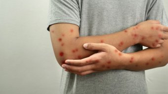 Bessere Mpox-Aufklärung